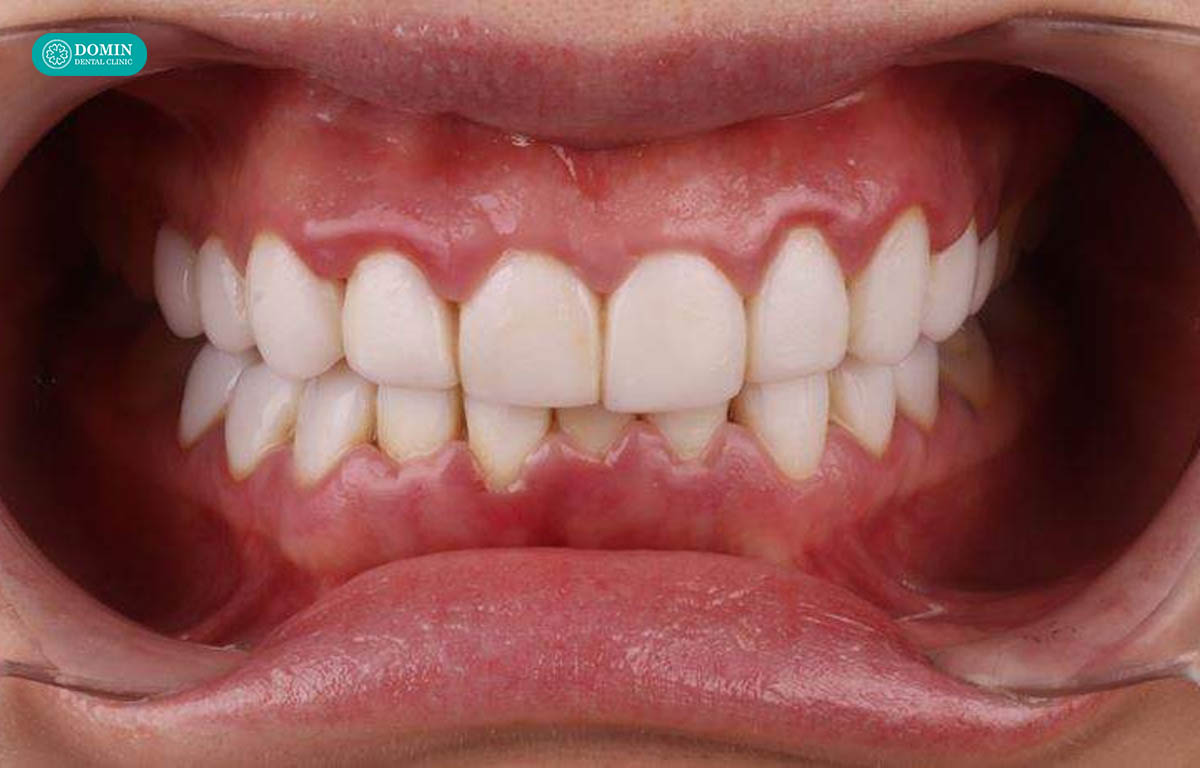 Dán sứ veneer sẽ không bền nếu thực hiện sai chỉ định.