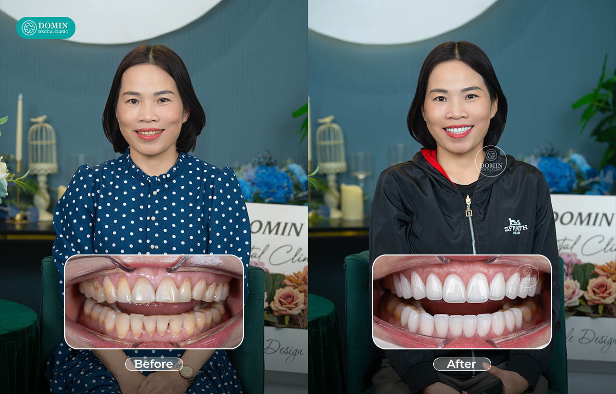 Dán sứ veneer DDBio tối ưu khả năng truyền sáng, cho cảm giác răng tự nhiên.