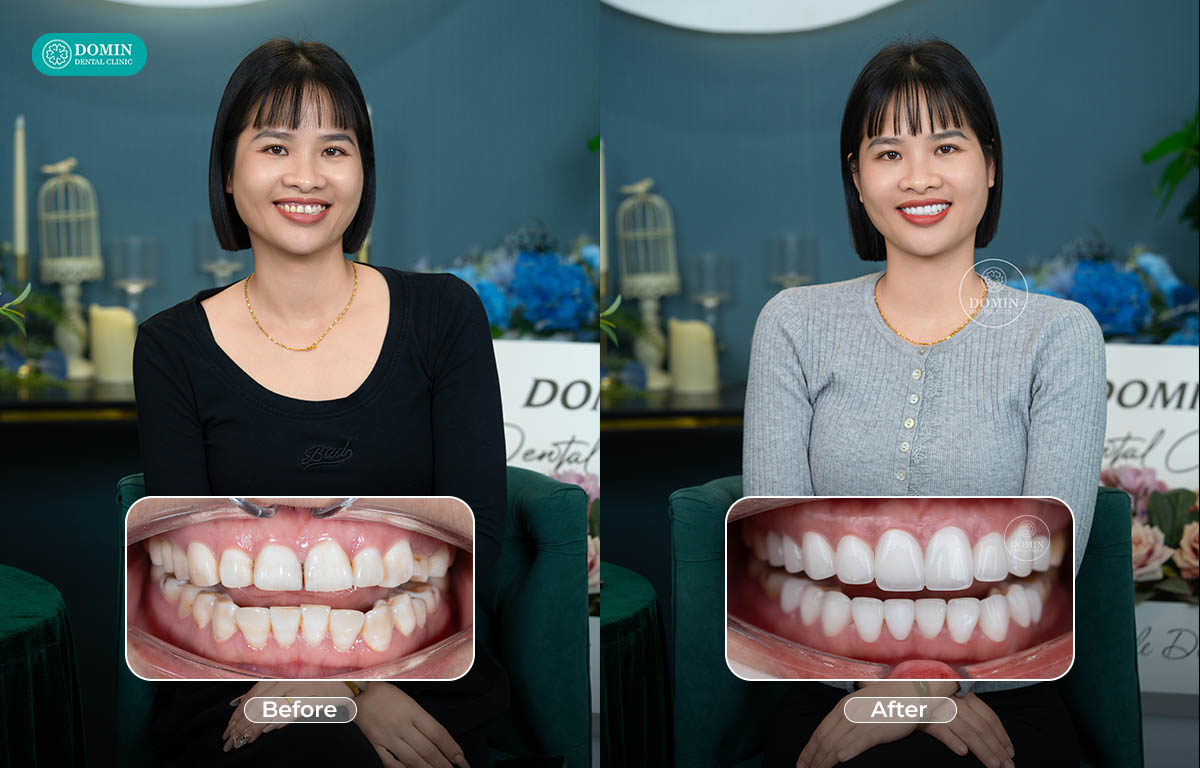 Khe thưa nhỏ là chỉ định lý tưởng để dán sứ. 