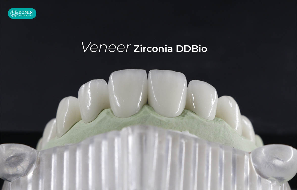 DDBio Veneer đảm bảo tính ổn định lâu dài khi sử dụng.