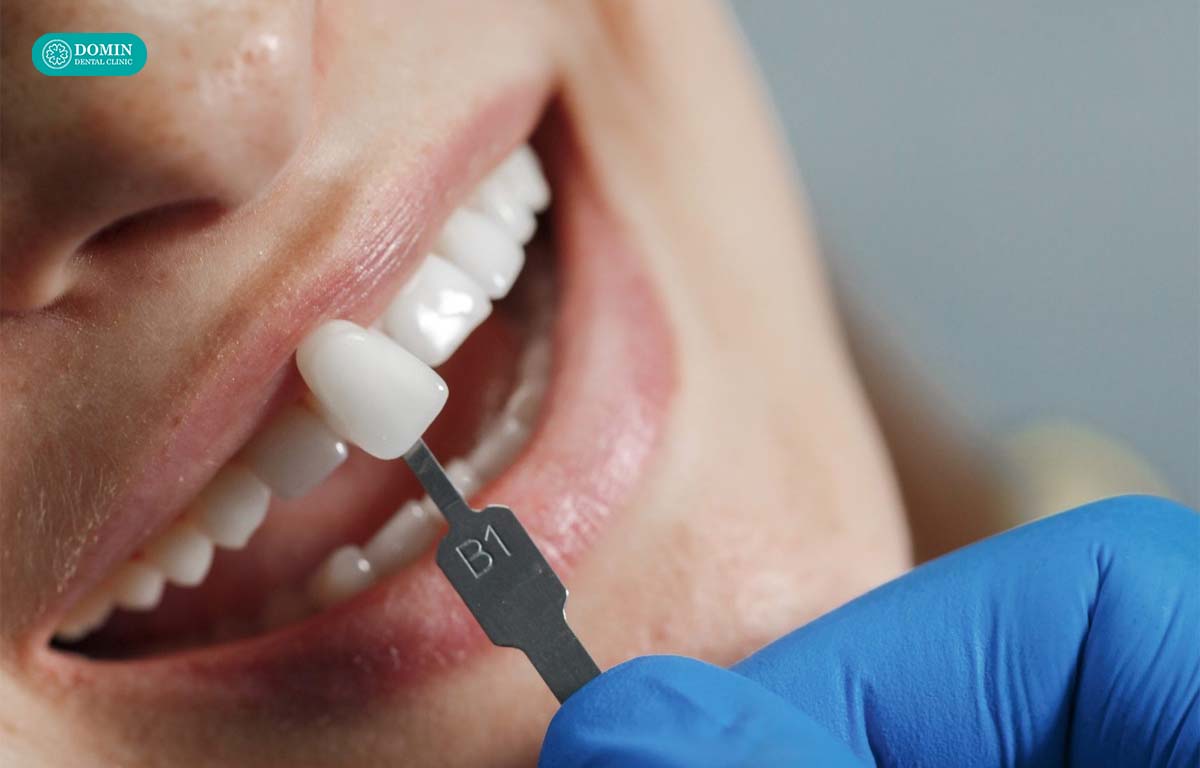 Dán sứ veneer 1 răng là kỹ thuật phục hình thẩm mỹ tối thiểu