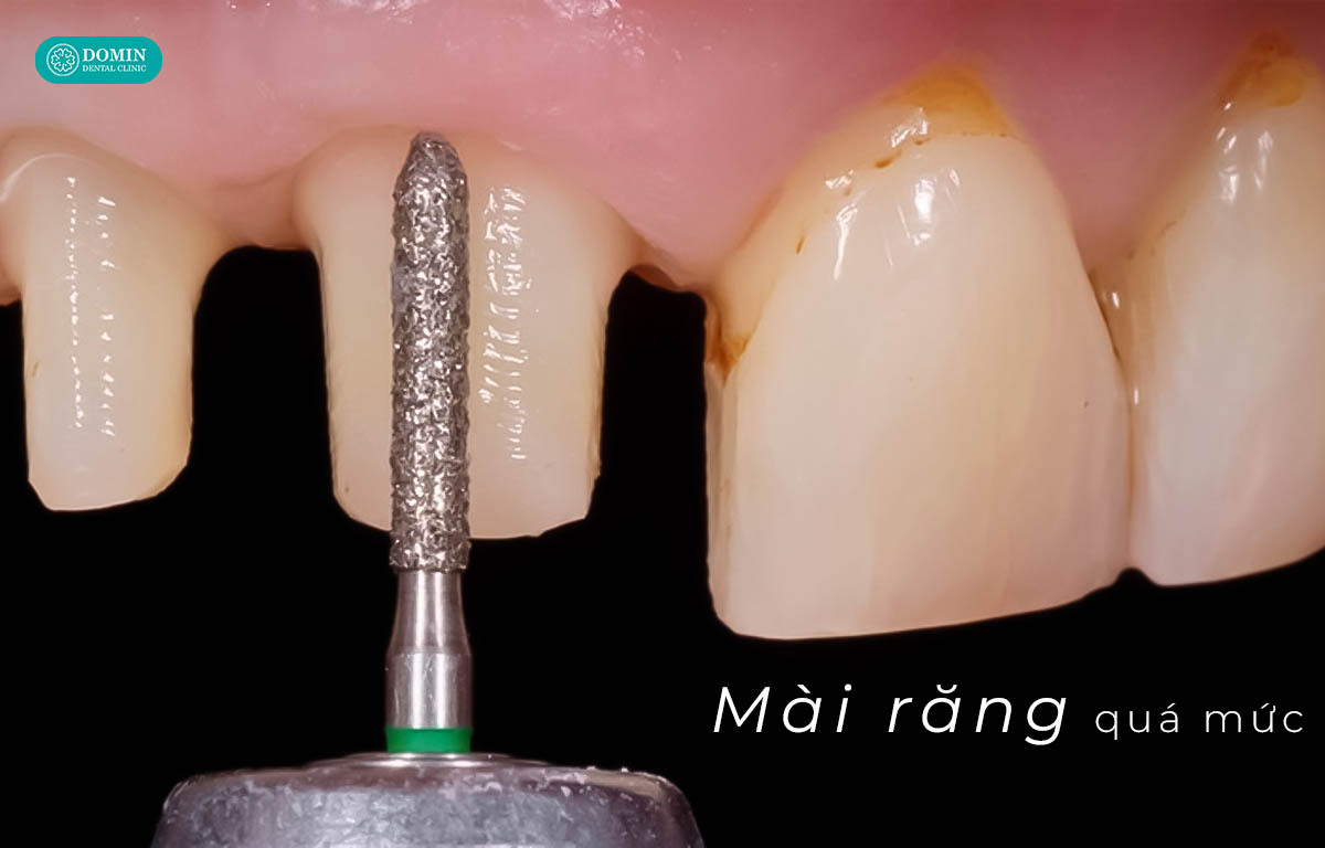 Mài răng quá nhiều làm kích thích tủy răng, gây ê buốt.