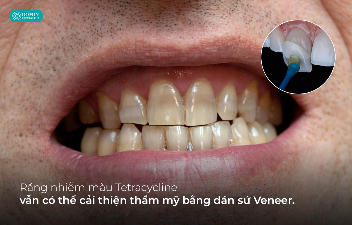 Răng nhiễm màu Tetracycline vẫn có thể cải thiện thẩm mỹ bằng dán sứ Veneer
