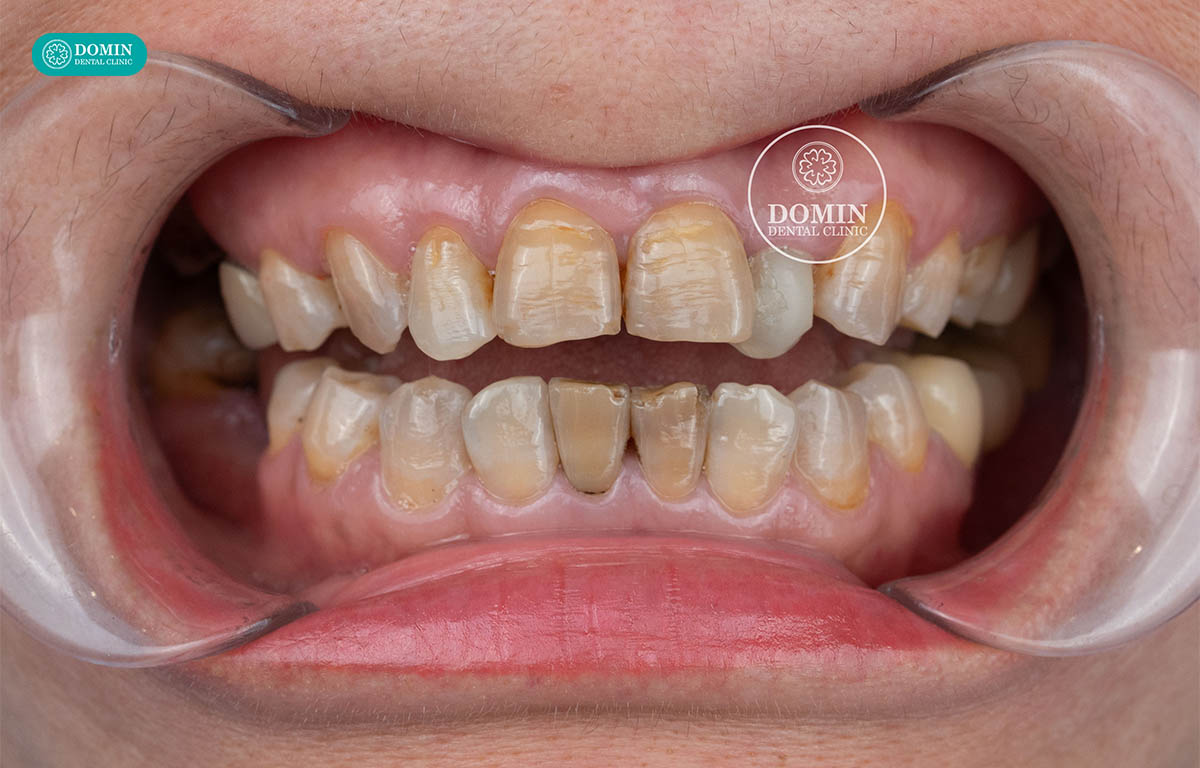 Răng nhiễm màu Tetracycline là tình trạng răng bị đổi màu do ảnh hưởng của kháng sinh Tetracycline