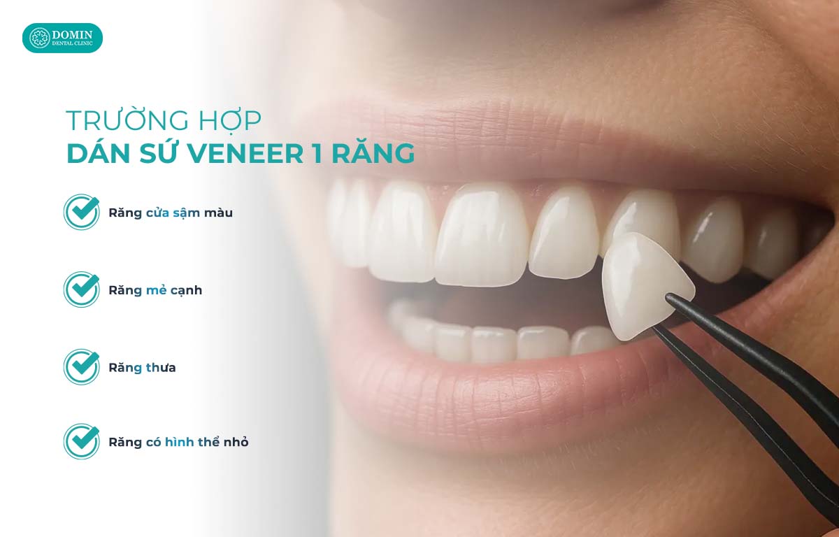 Trường hợp chỉ nên dán veneer 1 răng