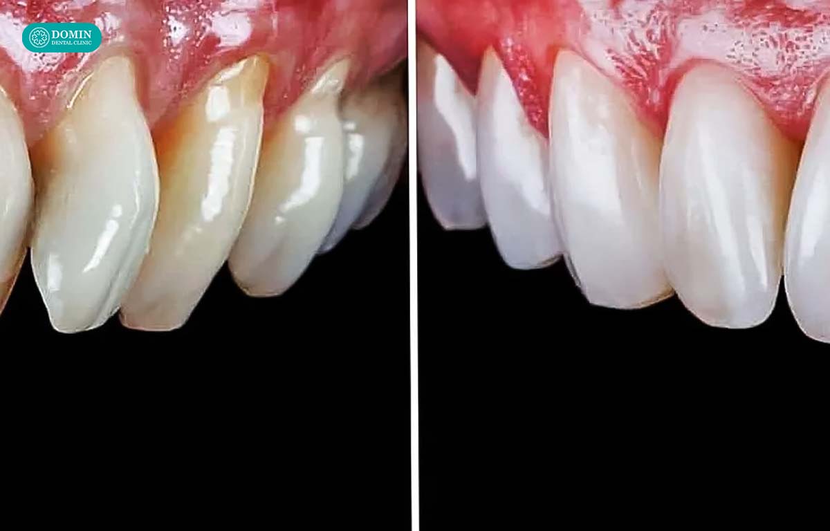 Dán sứ veneer răng hàm giúp tái tạo hình thể răng.