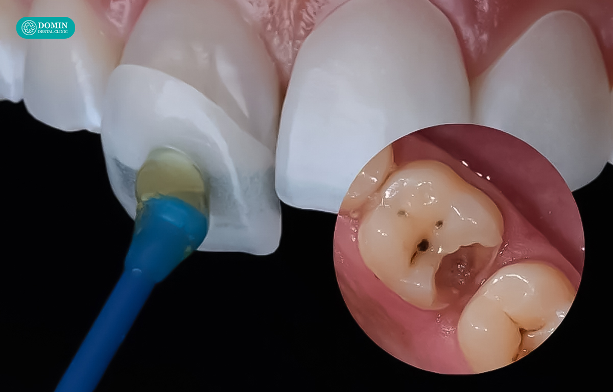 Thực hiện dán veneer cho răng sâu khi diện tích tổn thương nhỏ