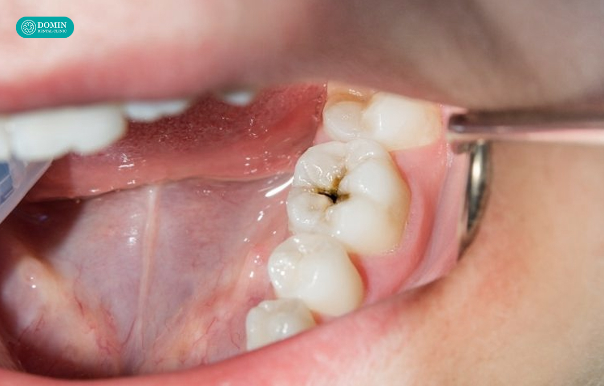Sâu răng lan vào tủy không nên dán sứ veneer.
